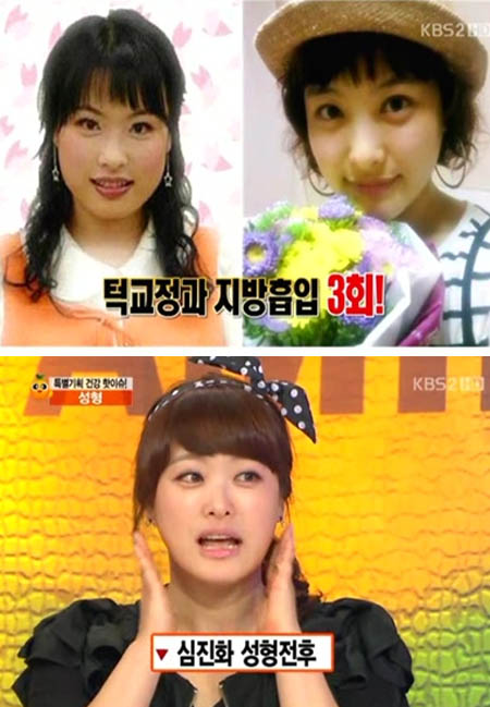 ▲방송에서 성형 전후 모습을 비교한 심진화 /사진=KBS 2TV 비타민 캡처