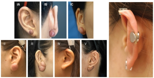 ▲귀걸이 후유증으로 생긴 흉덩어리(왼쪽)와 자석을 이용한 치료 모습