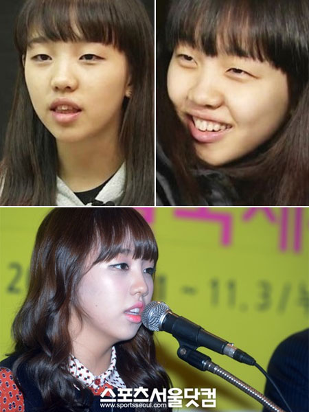 백아연의 라미네이트 시술 전(위)과 후 사진이 화제를 모았다. / 온라인 커뮤니티, 노시훈 기자