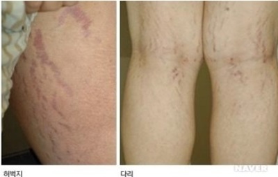 튼살 생기는 이유 인터넷 게시물이 누리꾼들의 관심을 끌고 있다. / 사진 출처=서울대 병원