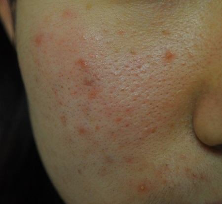 지루성피부염은 여드름과 같은 증상을 보여 오해하는 환자들이 많아 주의가 당부된다./고운결한의원 제공