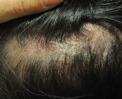 유전이 아닌 질환성 탈모는 체력 저하 및 면역력 저하로 인해 두피에 지루성피부염이 발병하는 경우도 적지 않아 예방이 중요하다./고운결한의원 제공