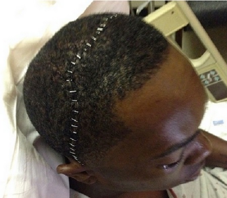 시범경기 도중 상대 타자의 타구에 얼굴을 맞고 쓰러진 신시내티 레즈의 광속 마무리 아롤디스 채프먼이 수술 후 머리에 핀을 박은 사진으로 자신의 근황을 알렸다고 25일 유럽의 한 언론이 보도했다. / 유럽 언론 캡처