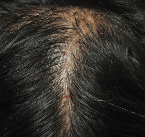 고운결한의원 인천점 정민희 원장은 “지루성두피염 초기라면 얼굴에 피지량이 많아지고 머리가 쉽게 기름지거나 두피가 가렵고, 비듬처럼 각질이 일어나는 증상이 있다”며 “질환이 진행되면 두피에 뾰루지가 나고, 붉어지거나 열감이 느껴지고 인설이 많이 생겨 검은 옷을 입기 어려울 정도가 된다”고 말했다.