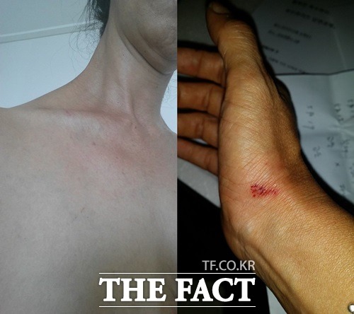 김부선이 공개한 폭행 당한 흔적들. /김부선 페이스북