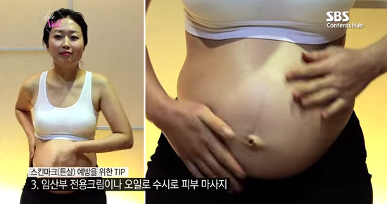 튼살이 생기는 이유는 피부의 엘라스틴 섬유와 콜라겐 손상인 것으로 밝혀졌다./ SBS contents Hurb 영상 캡처