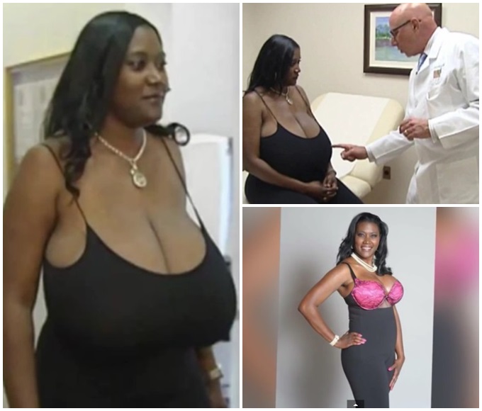 미국의 한 여성이 거대유방증으로 가슴이 계속해서 커져 고통을 겪다 최근 축소수술을 받은 사연이 보도됐다. /유튜브 영상 갈무리