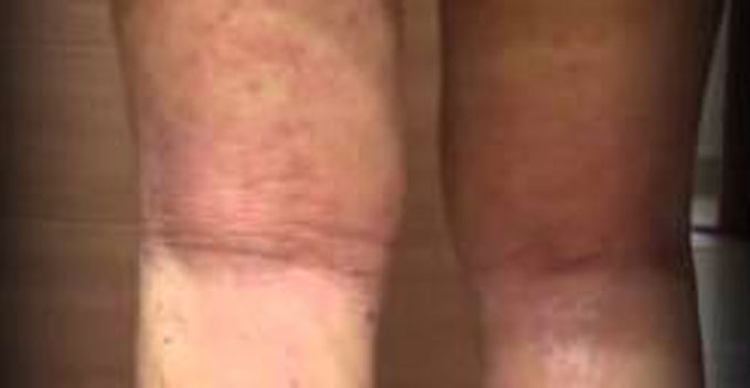 아토피 뜻에 대한 관심이 더욱 높아지고 있다. /유튜브 영상 캡처