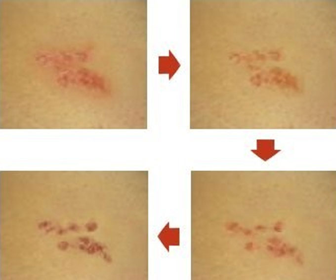 한국인은 매년 52만 9690명이 대상포진에 걸리는 것으로 밝혀진 가운데 해마다 여성 대상포진 환자의 수가 급격히 증가하면서 대상포진을 예상하는 법에 관심이 모이고 있다.  / 네이버 캡처