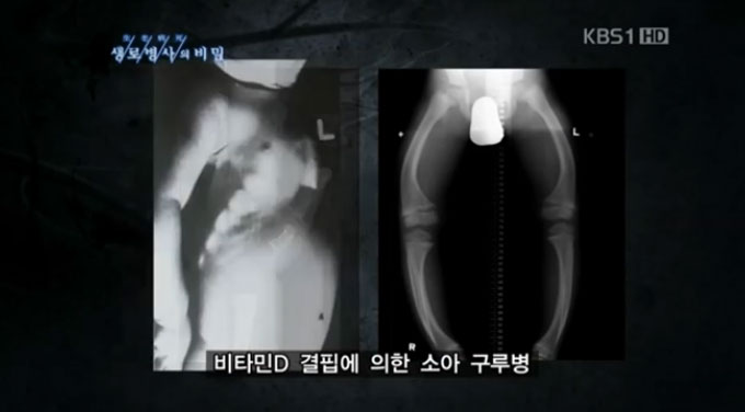비타민 D가 결핍되면 구루병에 걸릴 수 있다. 구루병은 어린이 성장에 장애를 일으킬 수 있어 특별히 주의해야 한다. /KBS 생로병사의 비밀 영상 갈무리