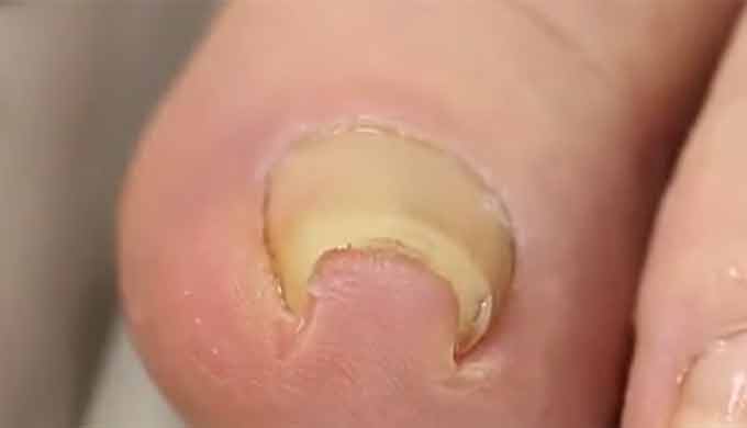 내향성 발톱 치료법이 눈길을 끌고 있다. 내향성 발톱 치료법은 가벼운 경우에는 파고들어간 손발톱의 모서리와 그 아래의 살 사이에 솜꾸러미나 치과용 치실을 끼어 주면 굳이 수술을 하지 않아도 치료가 될 수 있다. / 유튜브 캡처