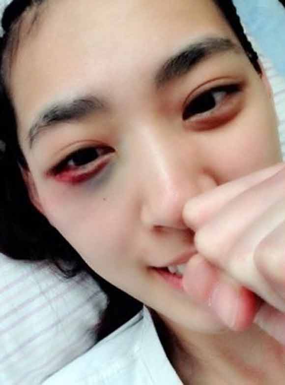 박지혜 영광의 상처. 박지혜가 화끈한 파운딩으로 로드 FC 데뷔전을 승리로 장식했다. 로드FC 측에서 제공한 박지혜의 경기 후 사진에서는 두 눈이 시퍼렇게 멍들어 보는 이들을 안타깝게 했다. / 로드FC 제공