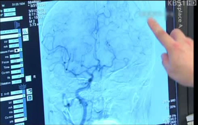 뇌경색 예방법, 겨울철에 특히 중요! 뇌경색 예방법은 혈관이 수축하는 겨울철에 특히 더 잘 알아둬야 한다. /KBS 방송 화면 캡처