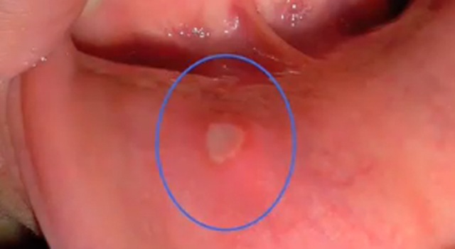 혓바늘이 생기는 원인, 방치하면 암 된다? 혓바늘이 생기는 원인과 예방법에도 혓바늘이 들어가지 않으면 설암의 가능성이 높다./ KBS 방송 화면 캡처