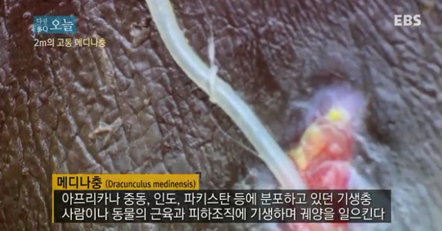 메디나충의 징그러운 생김새 메디나충에 대한 누리꾼들의 관심이 높아지고 있다. 메디나충은 인체나 동물의 몸에 기생하며 종양을 일으키는 기생충이다. /EBS 영상 갈무리