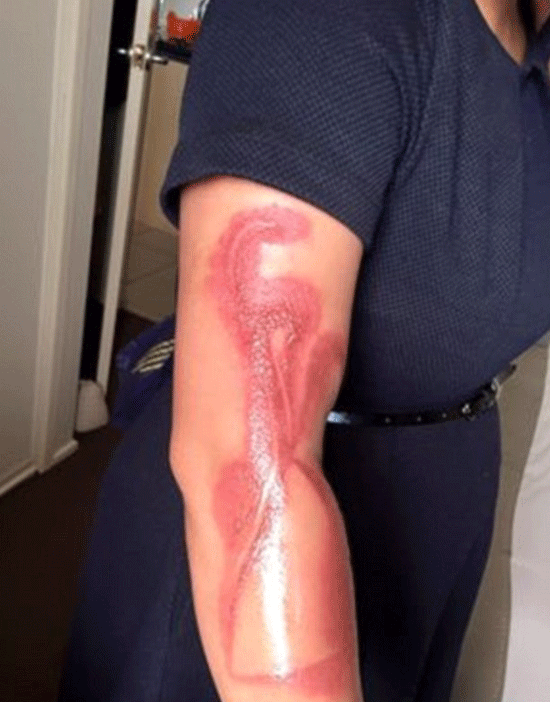 호주에서 충전기에 연결된 애플 ‘아이폰7’을 옆에 두고 잠들었다가 2도 화상을 입었다는 주장이 나왔다. /멜라니 페이스북