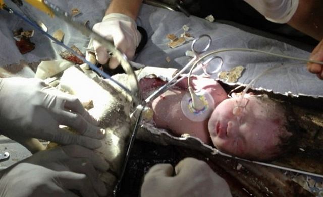 화장실 배수관에서 간신히 숨 쉬고 있던 영아 구조. 중국에서 한 여성이 화장실에 아이를 버렸다. 아이는 배수관에서 간신히 숨을 쉬어 살아 있었다. /위어블로그
