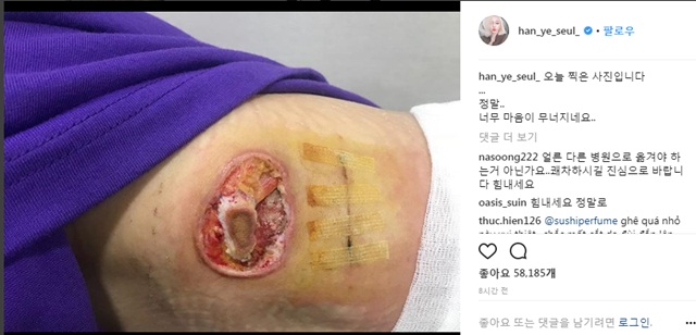 23일 한예슬은 또 다른 지방종 제거 수술 부위라는 설명과 함께 지방종 제거 흔적이 담긴 신체 부위 사진을 공개했다. /한예슬 SNS