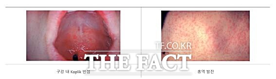 홍역으로 인한 구강 내 Koplik 반점과 발진. /미국질병관리본부