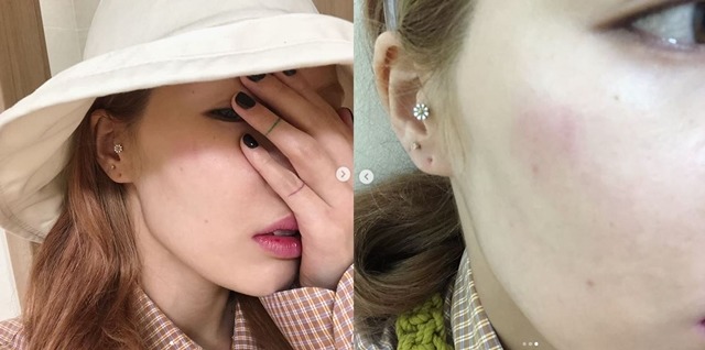 가수 현아가 부상을 입고 현재 상태에 대해 전했다. /현아 인스타그램