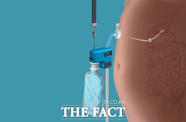 미국 의료기업체 어스파이어 바리아트릭스가 개발한 신개념의 체중조절장치. 일단 먹은 음식물이 위 속에서 소화되기 전 튜브를 통해 밖으로 빼내는 장치이다. 【어스파이어 바리아트릭스·AP/뉴시스】