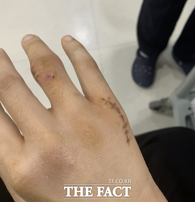 한국 여자배구 염혜선 선수가 2020-21 시즌 V리그를 준비하는 연습도중 블로킹을 하다 오른쪽 새끼손가락과 손등 사이 뼈가 부러지는 골절상을 입고 수술한 부위 모습. 염 선수는 통증을 이겨내고 도쿄올림픽에서 부상투혼을 보이며 4강 진출을 견인했다. /염혜선 선수 가족 제공