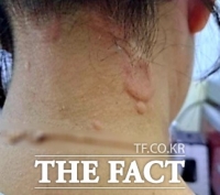  '죽을 듯한 ‘두드러기’와 ‘생리 불순’으로 힘들어요'...백신 부작용 '호소'