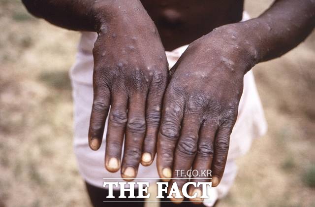 한스 클루주 WHO 유럽사무소 소장이 지난 달 31일(현지 시간) 성명을 통해 원숭이두창의 올해 여름 확산 가능성을 경고했다. /AP.뉴시스