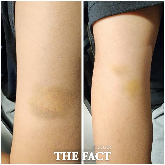 최근 밀양의 한 중학교에서 발생한 학교폭력 피해자의 모친이 공개한 피해 학생의 팔에 멍자국이 있다./보배드림 갈무리
