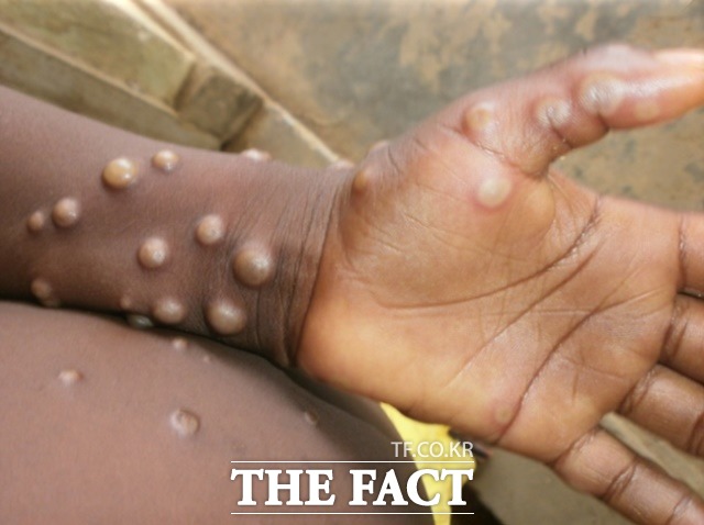 지난달 30일 부산에서 처음으로 엠폭스(MPOX·원숭이두창) 확진자가 발생했다. 사진은 엠폭스 주요 증상. /세계보건기구(WHO)