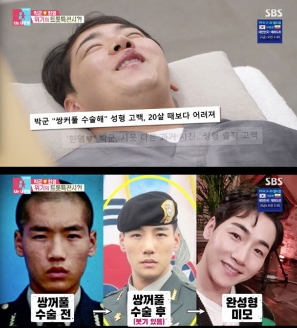 한영이 남편 박군이 쌍꺼풀 수술에 코 수술도 두 번 했다고 털어놨다. /SBS 방송 캡처