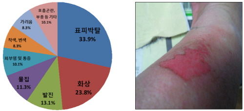 



한국소비자원이 공개 파스 부작용 유형(왼쪽)과 표피 박탈 부작용 사례.