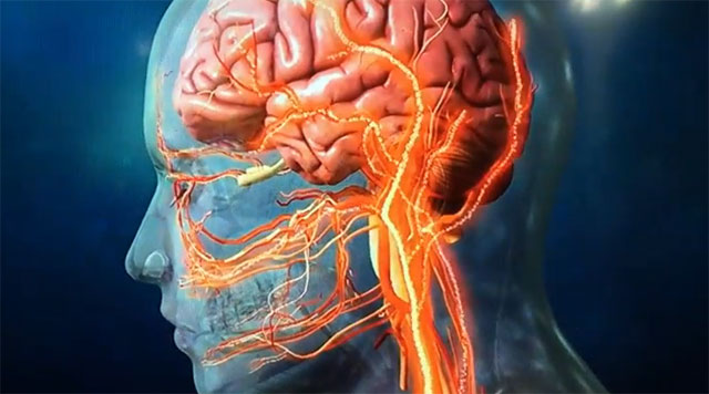 한경선 겪고 있는 뇌경색 어떤 질환인가? - 연예 | 기사 - 더팩트