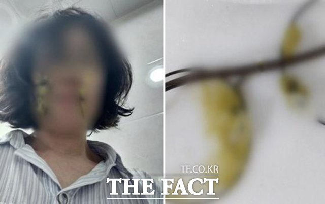 아동학대를 의심해 어린이집 교사를 똥 기저귀로 폭행한 40대 여성에게 실형이 선고됐다. /피해자가 폭행 당한 직후 촬영한 사진