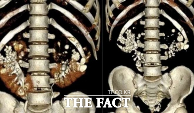 장시간 앉아 생활하며 물 대신 음료수를 마셔오던 베트남 남성의 수백 개 결석으로 가득찬 신장 CT 촬영 결과물. /하노이 E병원