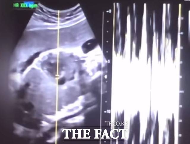 사진은 낙태한 산모의 유튜브 동영상에서 캡쳐한 초음파 사진과 심박 그래프./서울중앙지검