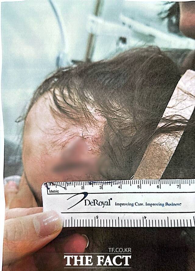 19일 <더팩트> 취재를 종합하면 A(4) 양은 지난해 2월 부모의 정형외과 진료를 위해 경기 안양시 P 병원을 찾았다가 철제 구조물에 부딪혀 이마가 찢어졌다. /독자 제공