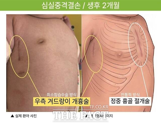 부천세종병원 우측 겨드랑이 최소침습수술. /부천세종병원