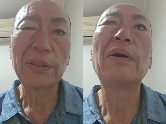 배우 유퉁이 결국 건강 악화로 활동을 잠정 중단했다. 최근 자신의 유튜브 채널을 통해 모습을 드러낸 유퉁은 한쪽 눈을 제대로 감지 못하고 입이 한쪽으로 돌아간 상태다. /유튜브 채널 '유퉁TV'